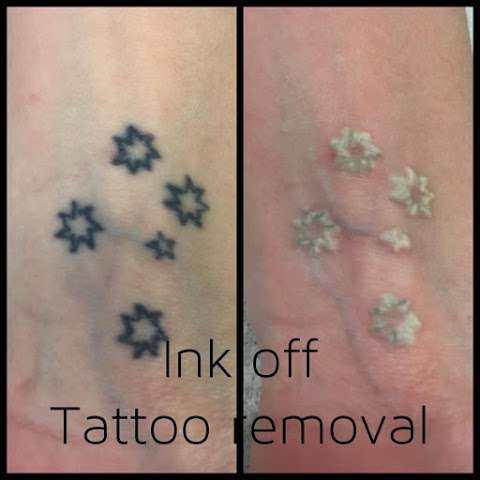Photo: Ink Off Tattoo Removal Australia